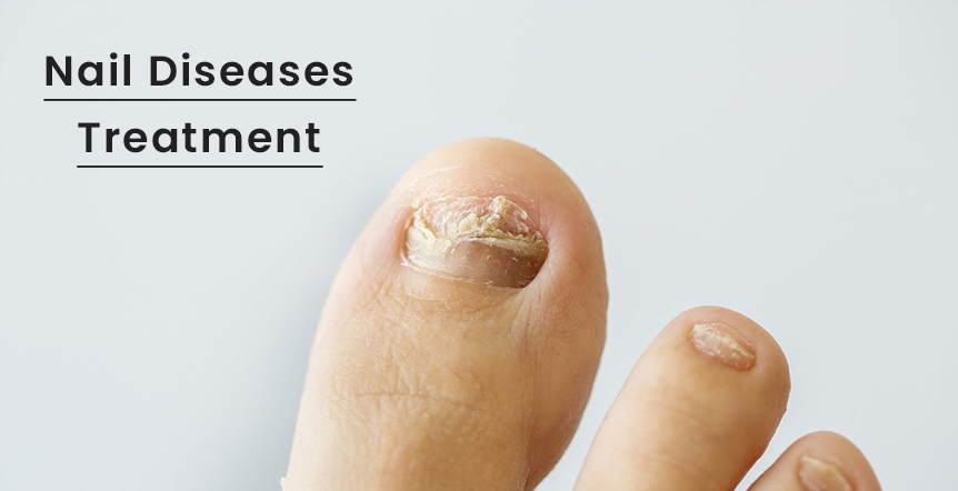 Nail Diseases Treatment